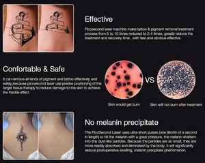 LASER PERMANENT TATTOO REMOVAL AT HOME