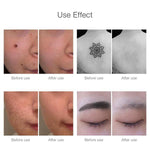 LASER PERMANENT TATTOO REMOVAL AT HOME