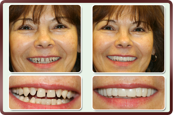 Best Smile Veneers X