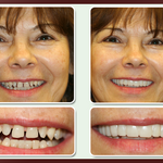 Best Smile Veneers X