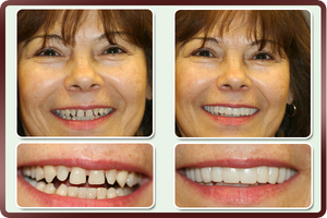 Best Smile Veneers X