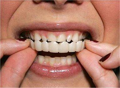 Best Smile Veneers X